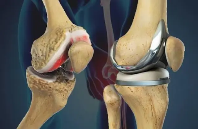 Knee Replacement in India for Mauritius Patients